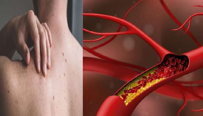Cholestrol Symptoms: कोलेस्ट्रॉल वाढल्यास शरीराच्या 'या' भागावर सर्वप्रथम दिसतात लक्षणं