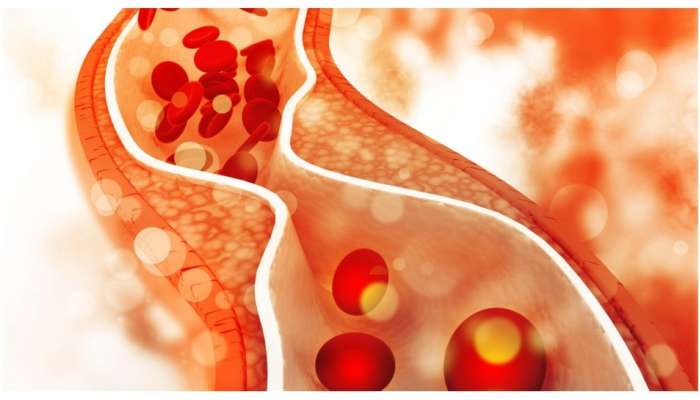 Cholesterol : कोलेस्ट्रॉलचा मोठा धोका, हिवाळ्यात चुकूनही या गोष्टींचे सेवन करु नका 