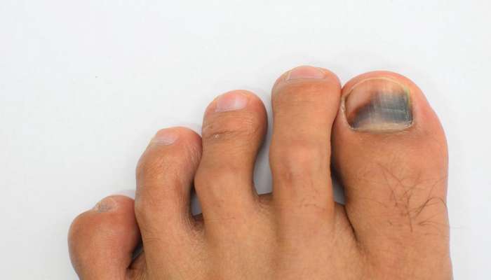 Black toe nail: पायांची नखं काळी पडताहेत का? असू शकतात गंभीर आजाराची लक्षणं...वेळीच व्हा सावध !