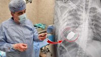 डॉक्टरांनी लष्करातील जवानाच्या शरीरातून बाहेर काढला जिवंत ग्रेनेड; X-Ray व्हायरल