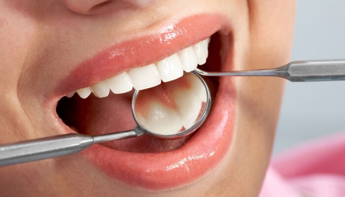 Teeth Cleaning: मोत्यासारखे पांढरे शुभ्र हवेत? &#039;हे&#039; घरगुती उपाय करून पाहा