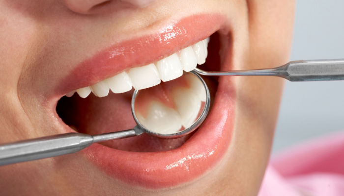 Teeth Cleaning: मोत्यासारखे पांढरे शुभ्र हवेत? 'हे' घरगुती उपाय करून पाहा