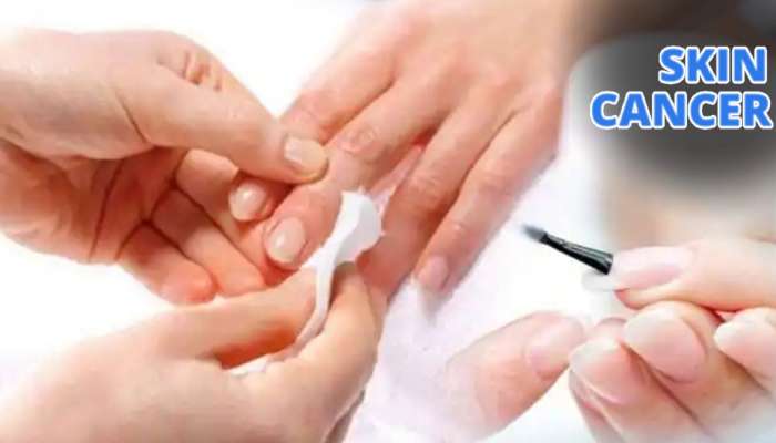 Cancer Infection Manicure: नखांचं सौंदर्य वाढवण्यासाठी केलेल्या मॅनीक्युअरमुळे झाला कॅन्सर; डॉक्टरांनी सांगितलं नेमकं कारण