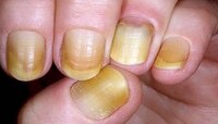 Yellow Nails : हाताची नखं झालीत पिवळी 'हे' घरगुती उपाय वापरल्यास नक्कीच होईल फायदा