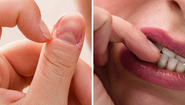 How to Stop Biting Your Nails : नखं चावण्याची सवय सुटत सुटेना ? या  टिप्स मदत करतील..