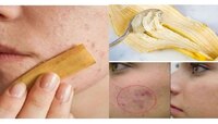 Pimple Remedies: एका रात्रीत चेहऱ्यावरचे पिंपल्स घालवायचे आहेत? हे घरगुती उपचार...