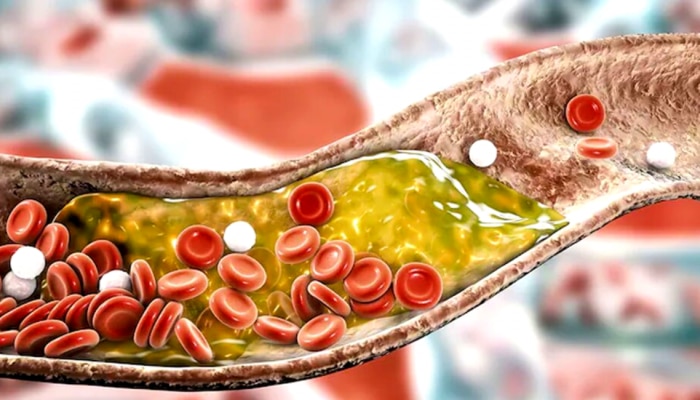 Cholesterol: बॅड कोलेस्ट्रॉल कमी करण्यासाठी किचनमधील &#039;हा&#039; पदार्थ करेल तुमची मदत!