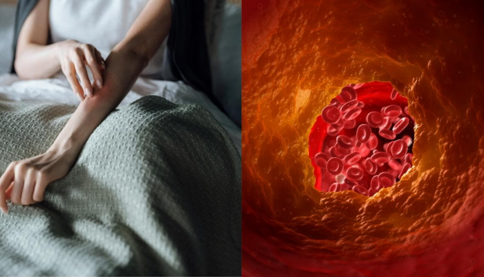 शरीरात cholesterol वाढलं असेल तर तुमच्या हातांमध्ये दिसतील 'असे' बदल