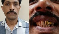 सोन्याच्या दातांनी गेम केला! 2007 साली झालेल्या चोरीचा मास्टरमाइंड 2023 मध्ये सापडला