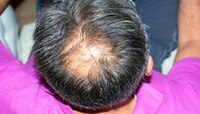 Baldness: टक्कल हळूहळू वाढत चाललंय? केस गळणं थांबवण्यासाठी 'हे' घरगुती उपाय पाहा