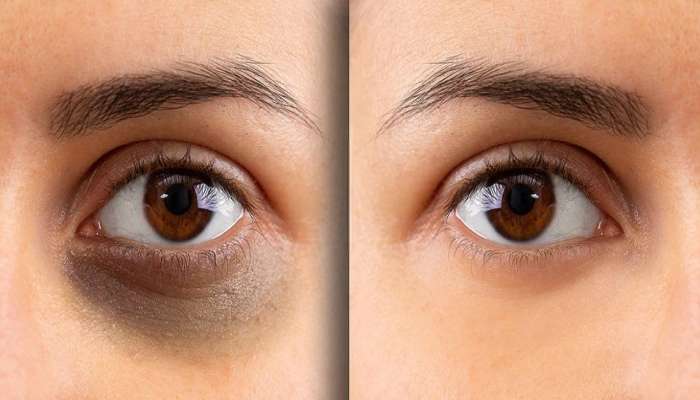 Beauty Tips : 8 सोप्पे उपाय आणि तुमच्या डोळ्यांखालची काळी वर्तुळं गायब!