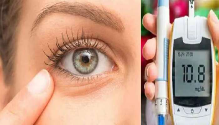 Diabetes Symptoms from Eye: तुमच्या डोळ्यात दिसतात डायबिटिजचे संकेत? &#039;या&#039; लक्षणांकडे दुर्लक्ष करू नका...