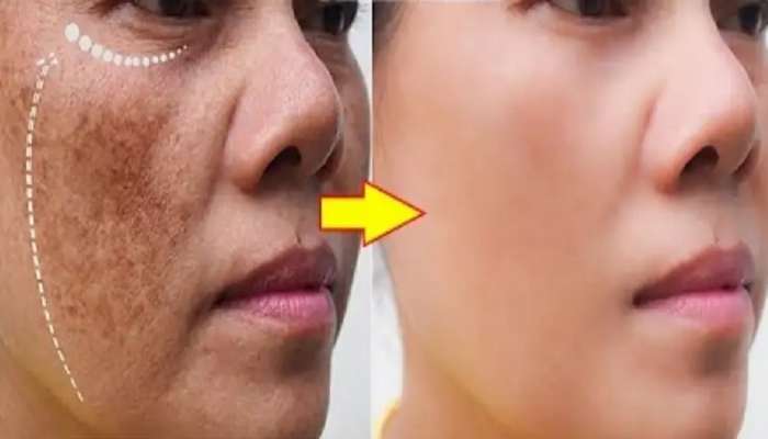 Skincare : चेहऱ्यावर वांग का पडतात ? वांग घालवण्याचे सोप्पे उपाय जाणून घ्या 
