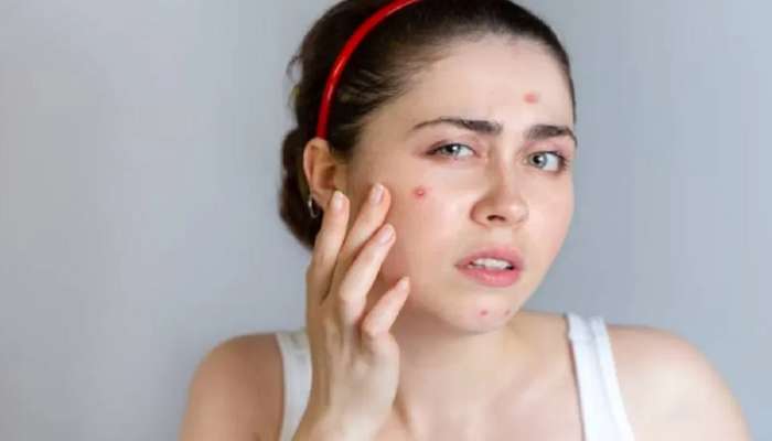 Pimples Removing Tips: चेहऱ्यावरील पिंपल्स आणि काळ्या डागांमुळे आहेत त्रस्त? मग आजच करा हे घरगुती उपाय..