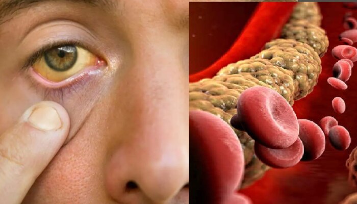High Cholesterol signs: तुमच्या डोळ्यांमध्ये दिसतील वाढलेल्या कोलेस्ट्रॉलची लक्षणं, दुर्लक्ष करू नका!