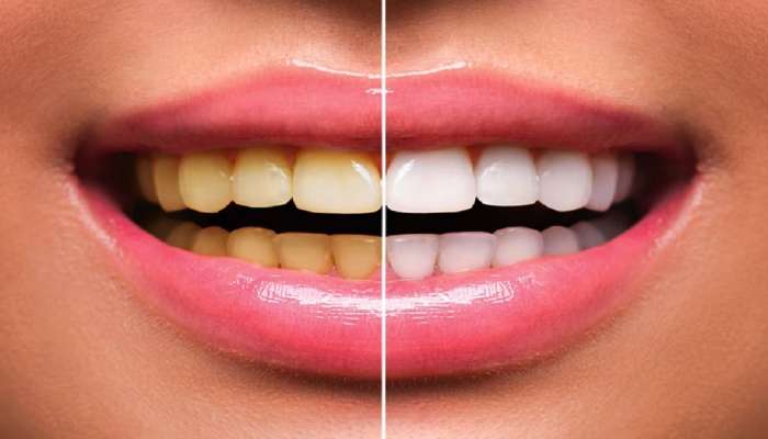 Teeth Whitening Tips : दातांचा पिवळेपणा जात नाही? करा &#039;हे&#039; घरगुती उपाय