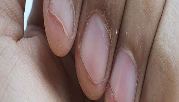 nail peeling causes near fingertips know the home based remedies 