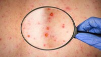 Monkeypox: पाकिस्तानपर्यंत पोहोचला मंकीपॉक्स, भारताला यामुळं किती धोका? 