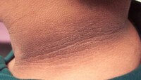 Dark Neck: मानेवरचे काळे डाग घालवायचे असतील पहा 'या' टिप्स