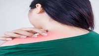 Summer Skin Care : घामोळ्यांपासून सुटका कशी मिळवाल? जाणून घ्या उपाय 