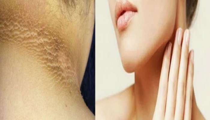 Neck Skin Tips : काळ्या पडलेल्या मानेवर &#039;हे&#039; घरगुती उपाय करा, त्वचा होईल स्वच्छ व सुंदर! 