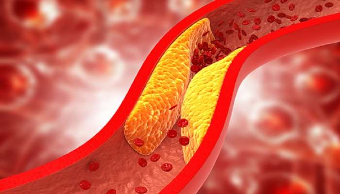 Bad Cholesterol दूर करण्यासाठी कोणती फळे खावीत? जाणून घ्या... 