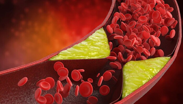 High Cholesterol : &#039;हे&#039; पदार्थ रक्तातील खराब कोलेस्टेरॉल दूर करण्यासाठी ठरतील फायदेशीर