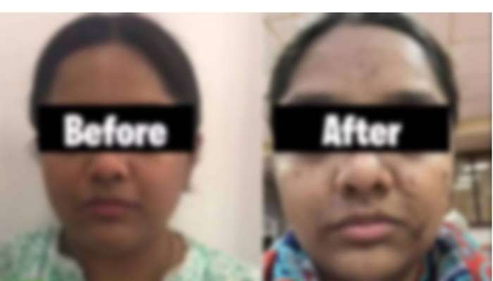 17 हजारांचे फेशिअल महागात पडले, मुंबईतील महिलेचा संपूर्ण चेहराच बिघडला