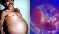 36 वर्ष 'तो' गरोदर होता, फुगलेले पोट पाहून डॉक्टरांचा झाला भलताच समज, ऑपरेशन करताच..