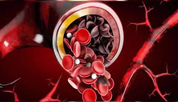 Sickle Cell Anemia: 7 कोटी नागरिक सिकलसेल अ‍ॅनिमियाचे रुग्ण; लक्षणे, उपचार जाणून घ्या 