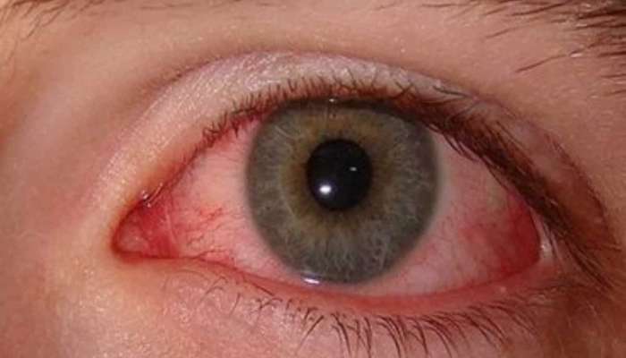 पावसाळ्यात वेगाने वाढतायत Eye फ्लूचे रुग्ण, लक्षणे आणि उपाय जाणून घ्या 