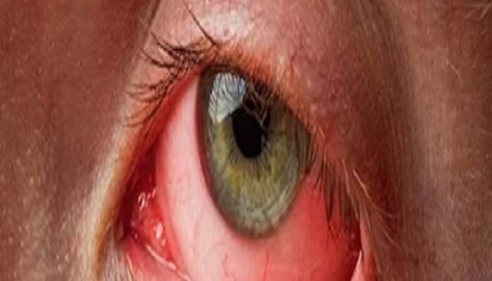 eye flu natural treatment these 7 home remedies in marathi 