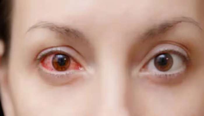 Eye Flu Myths : डोळ्यात डोळे घालून बघितल्यास खरंच संसर्ग होतो? येथे वाचा
