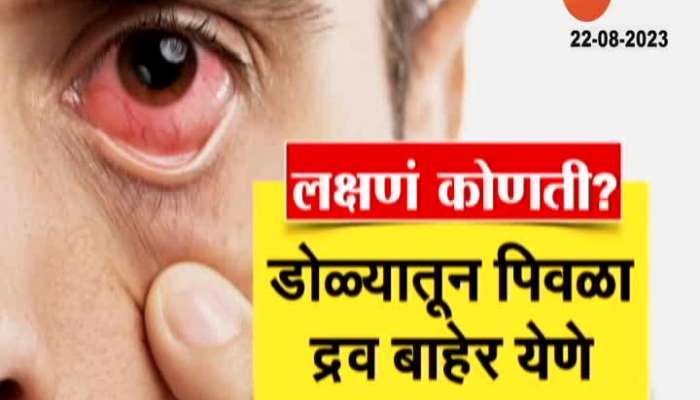Stymptoms And Precautions For Rising Conjunctivitis In Maharashtra