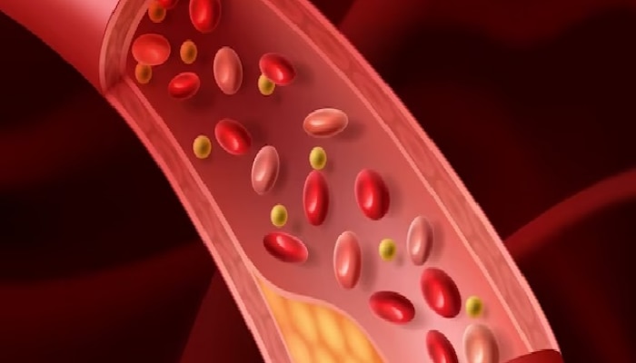 High Cholesterol Signs: शरीरात कोलेस्ट्रॉल वाढल्यास &#039;या&#039; भागांमध्ये होतात अधिक वेदना