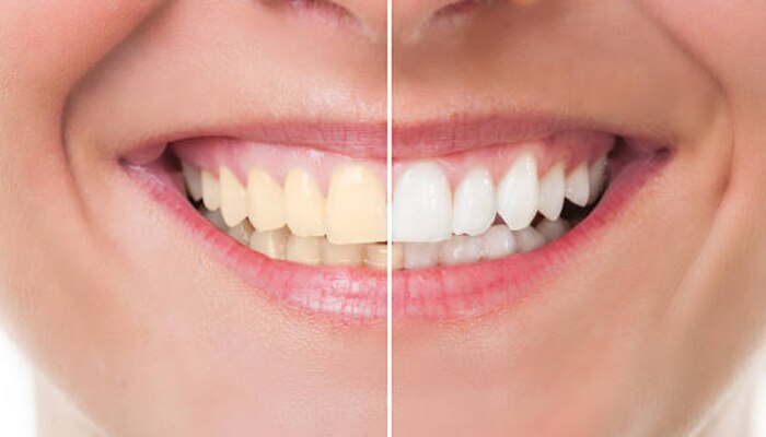 दातांवरचा पिवळा थर 6 आयुर्वेदिक उपायांनी होईल साफ, मोत्यासारखे चमकतील दात