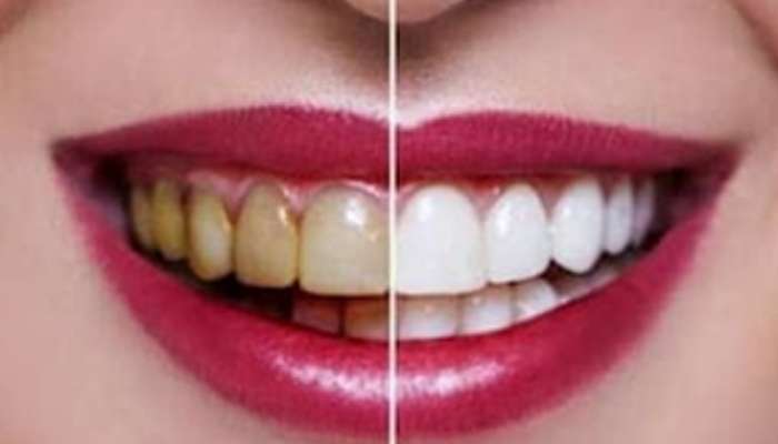 Teeth will shine with this home remedy Marathi News 