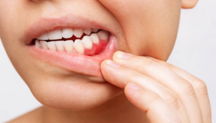 तोंडातील &#039;या&#039; भागांच दुखणं म्हणजे Mouth Cancer चे लक्षणं, दातदुखीकडेपण करू नका दुर्लक्ष