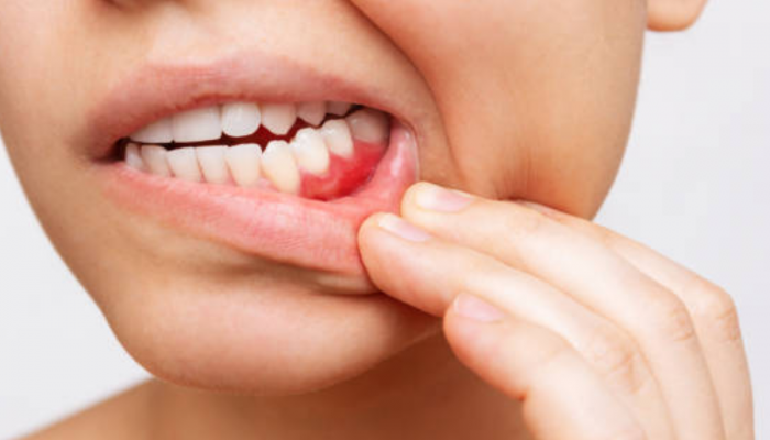 तोंडातील 'या' भागांच दुखणं म्हणजे Mouth Cancer चे लक्षणं, दातदुखीकडेपण करू नका दुर्लक्ष