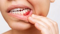 तोंडातील 'या' भागांच दुखणं म्हणजे Mouth Cancer चे लक्षणं, दातदुखीकडे लक्ष द्या