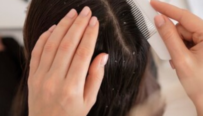 Why is Dandruff a Problem in Hair in winter