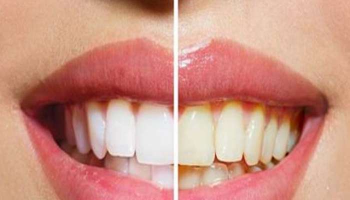 Yellow Teeth Whiten Paste home remedies Marathi News