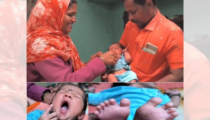 धाराशिव जिल्ह्यात वैद्यकीय क्षेत्रातील दुर्मिळ घटना, 24 बोटांचे बाळ आले जन्माला