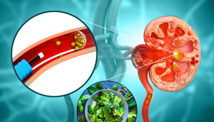 Kidney Stone Causing Vegetables : अजिबात खाऊ नका, &#039;या&#039; 7 भाज्यांमुळे होतो मुतखडा