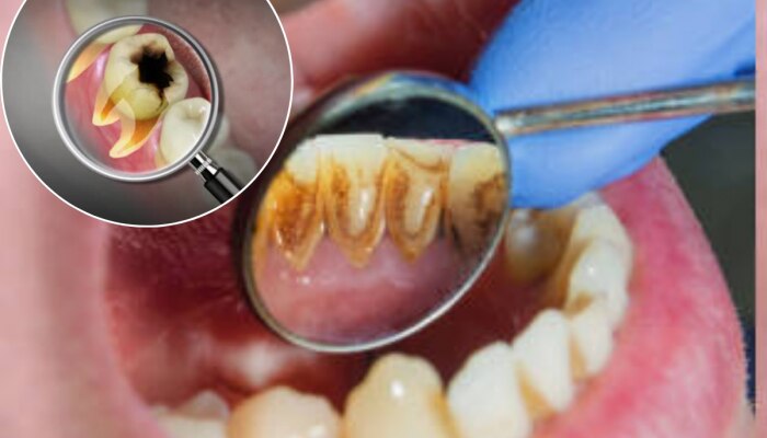 दातांना किड लागल्यामुळे निकामी झालेत दात, टीथ कॅविटीवर रामबाण आहे घरगुती उपाय 