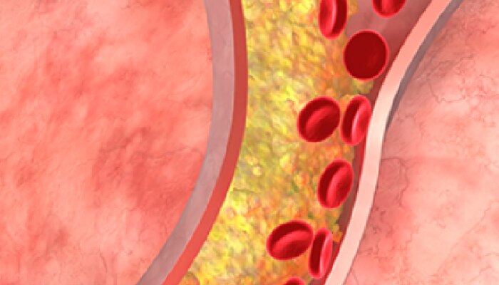 Cholesterol: ‘या’ कारणांमुळे शरीरात अचानक वाढू शकतं कोलेस्ट्रॉल