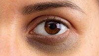 Dark Circles : डोळ्याखालचे डार्क सर्कल्स कमी करण्यासाठी 'हे' उपाय करा..! 