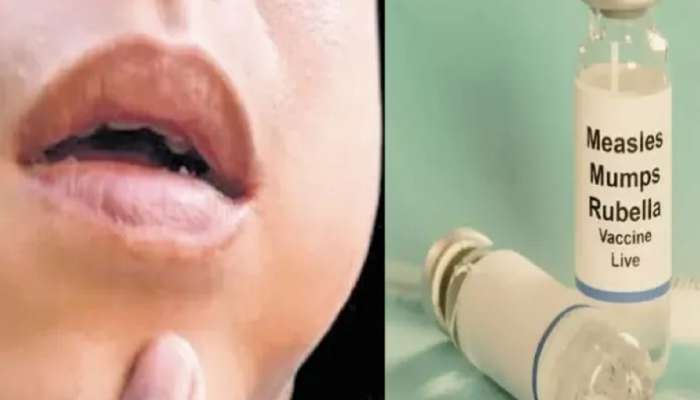 Mumps : सावधान! गालगुंडची साथ वाढतेय, दिवसभरात 190 रुग्ण, पाहा लक्षणे आणि उपचार 