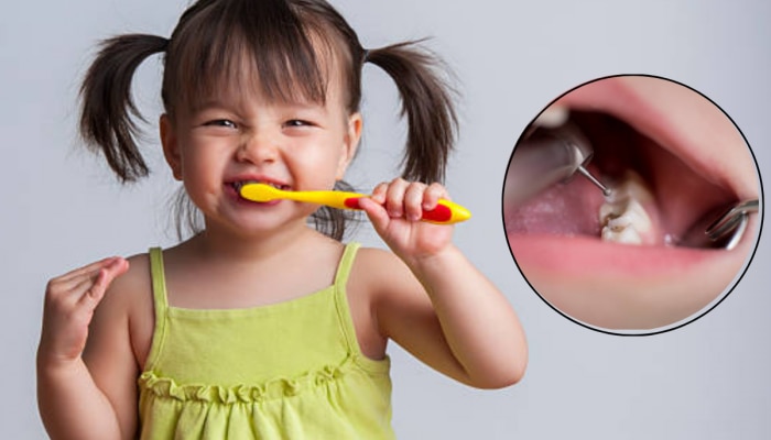 World Oral Health Day 2024 : मुलांच्या दातांमध्ये &#039;या&#039; 5 कारणामुळे लागते किड
