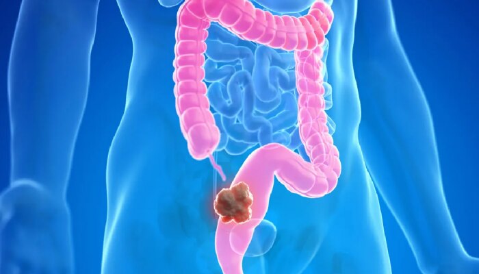 Colon cancer: शरीरात &#039;हे&#039; बदल दिसली तर वेळीच व्हा सावध; आतड्यांचा कॅन्सरची लक्षणं पाहा